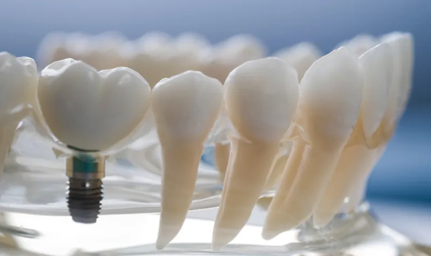 Image of Dental Implants-Everything You Need To Know About Dental Implants