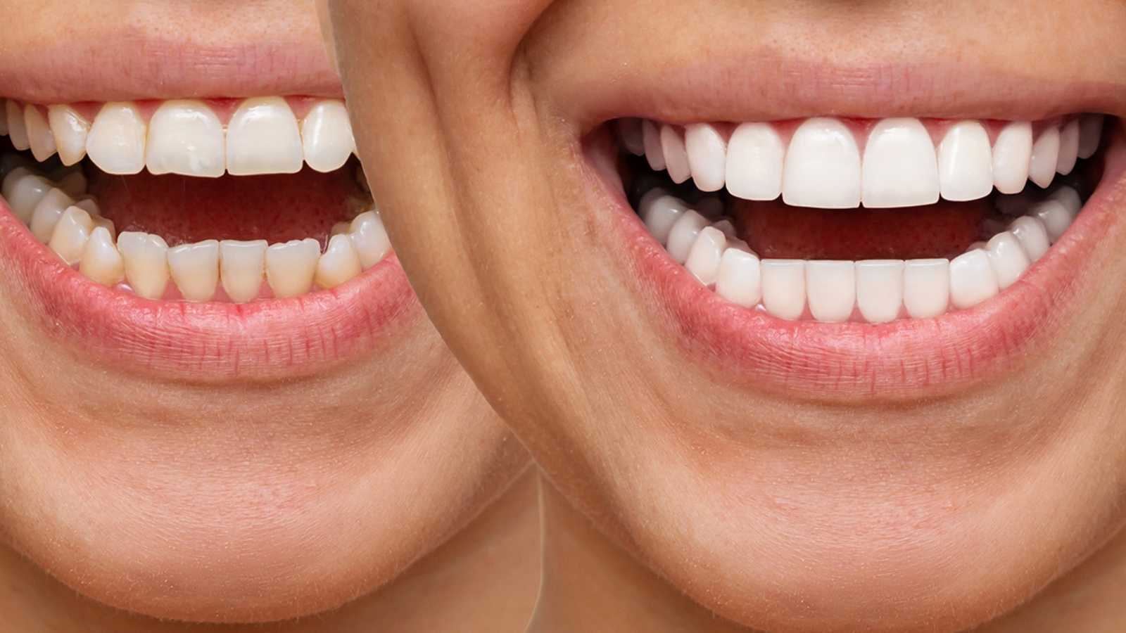 10 Lifestyle Tips for a Perfect Smile After Dental Veneers