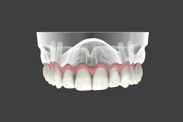 Are Implant Supported Dentures Permanent from Town Square Dentistry in Boynton Beach, FL