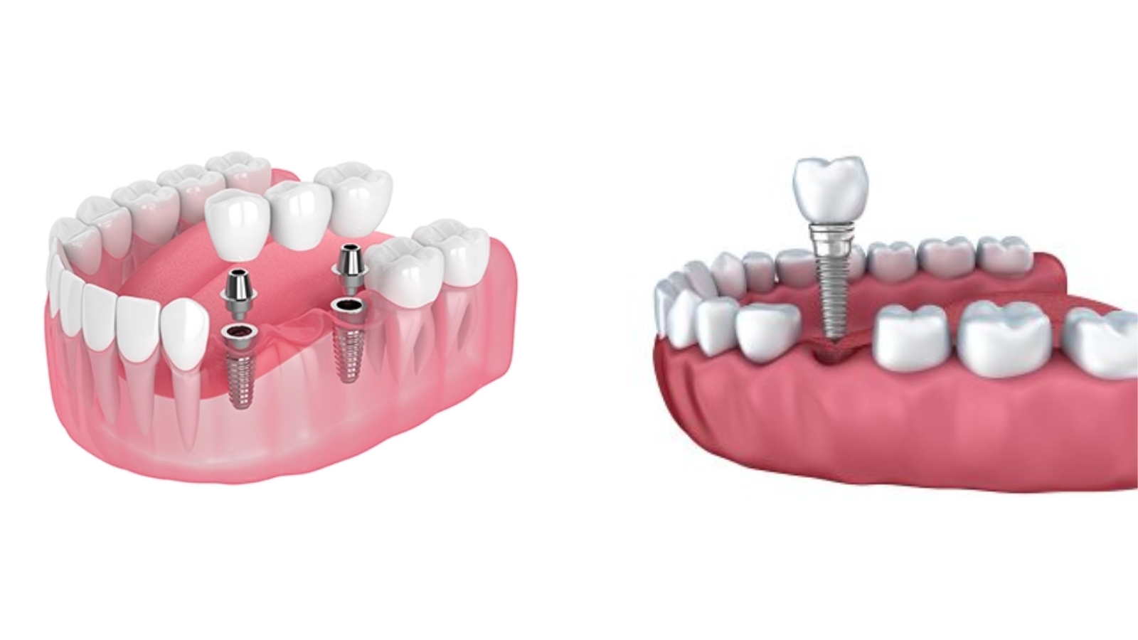 Bridges vs. Implants Which Best Mimics the Feel of Natural Teeth?