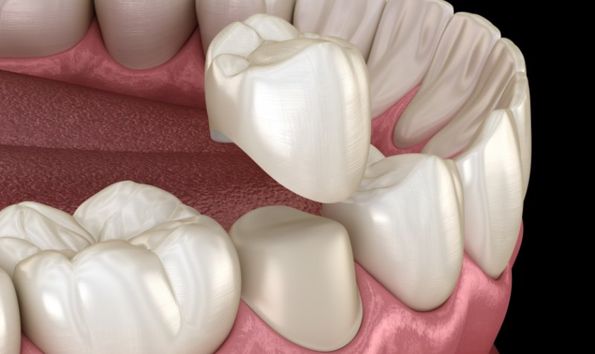 Crowning Achievements: Why Dental Crowns Are Perfect For The New Year