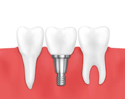 Recovery &#   ; After Care Tips For Dental Implants