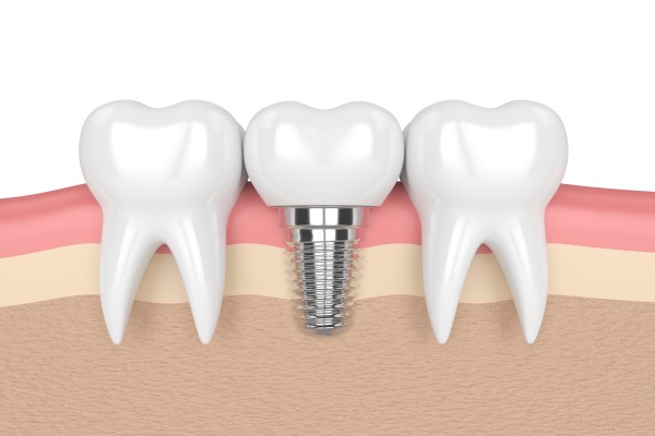 Get A New Permanent Tooth With A Dental Implant