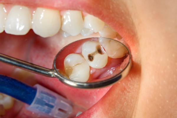 Four Tips For Cavity Prevention