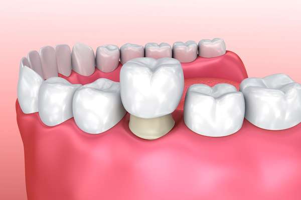 Permanent Dental Crowns vs. Temporary: Is There a Difference from Town Square Dentistry in Boynton Beach, FL