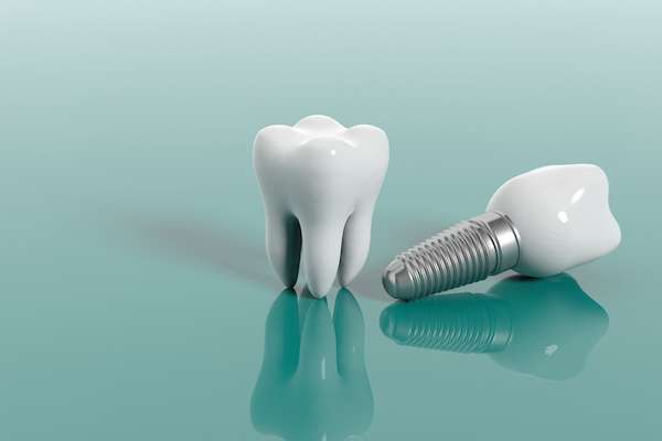 Multiple Teeth Replacement Options: One Implant for Two Teeth from Town Square Dentistry in Boynton Beach, FL