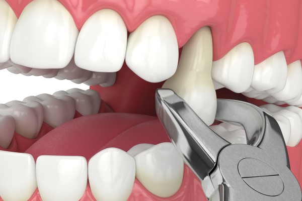 What Occurs During A Tooth Extraction Procedure?