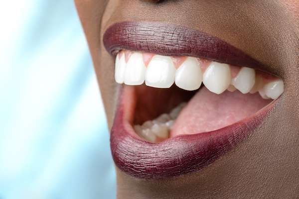 Routine Dental Care: What Are Tooth Colored Fillings from Town Square Dentistry in Boynton Beach, FL